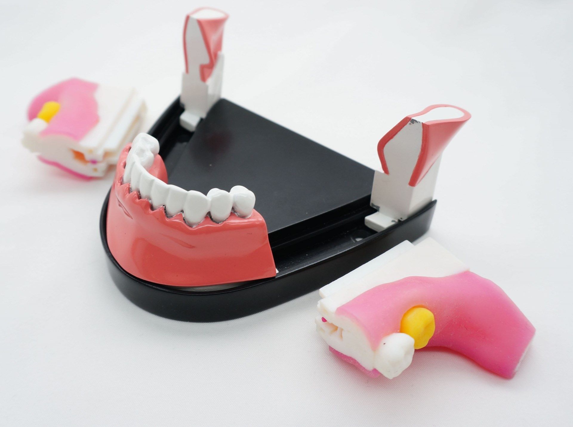 3rdmolar