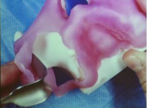 zygoma