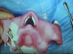 zygoma
