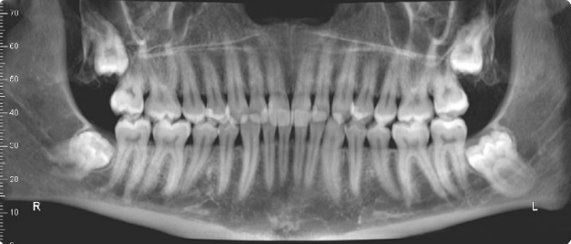 3rdmolar